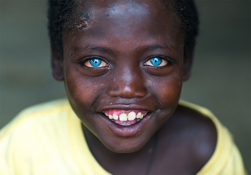 Abushe: The Ethiopian Boy Bullied For His Beautiful Blue Eyes